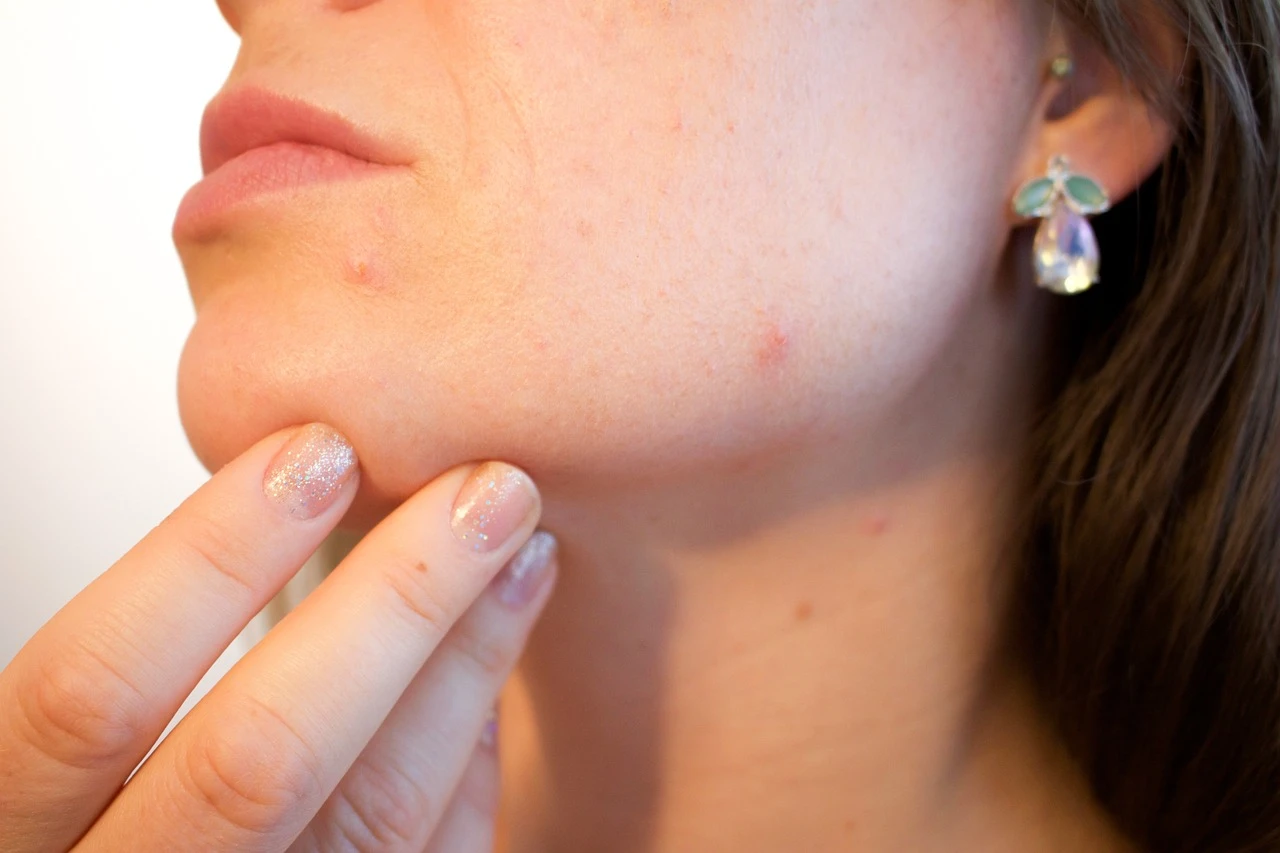 « L’Hydradermabrasion : Une Solution Efficace Contre l’Acné »